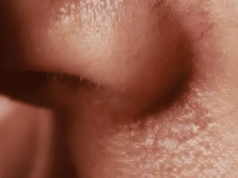 Luomen poisto before example 1