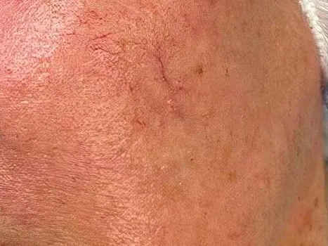 Luomen poisto before example 3