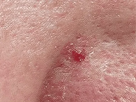 Luomen poisto before example 2