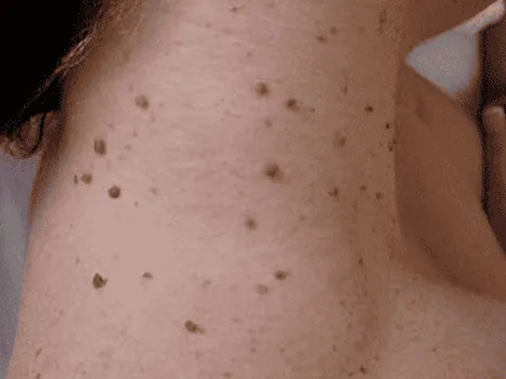 Luomen poisto before example 2