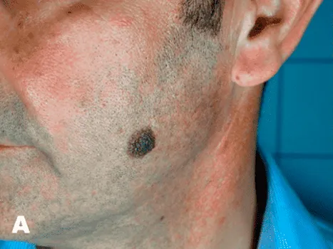 Luomen poisto before example 7