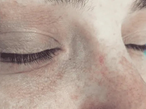 Luomen poisto after example 1