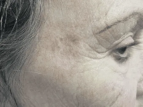 Luomen poisto after example 1