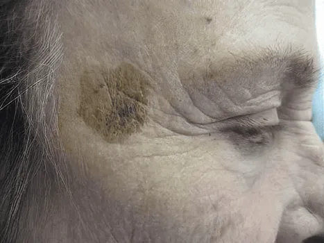 Luomen poisto before example 1