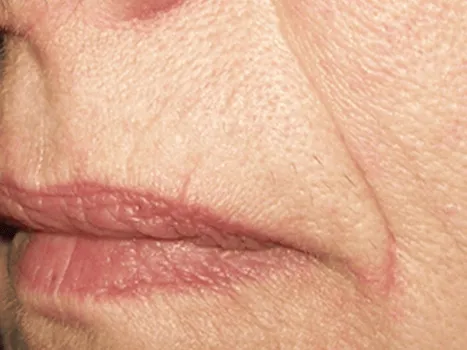 Luomen poisto after example 2