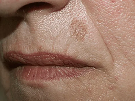 Luomen poisto before example 2