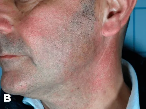 Luomen poisto after example 3