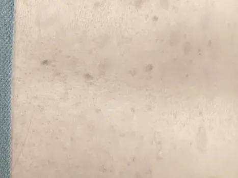 Luomen poisto after example 4