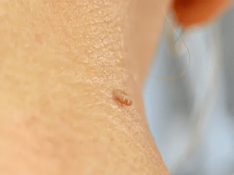 Luomen poisto before example 1