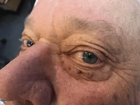 Luomen poisto before example 4